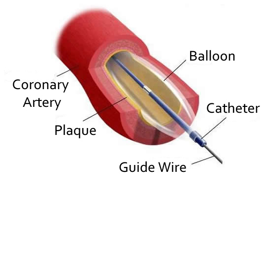 Guide Wire (Angioplasty)